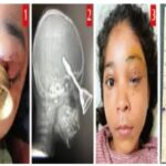 Diwali Accident: A tragic Diwali accident in Bilaspur! A prayer bell entered the eye of a 10-year-old child... A successful operation was performed at DKS.