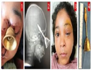 Diwali Accident: A tragic Diwali accident in Bilaspur! A prayer bell entered the eye of a 10-year-old child... A successful operation was performed at DKS.