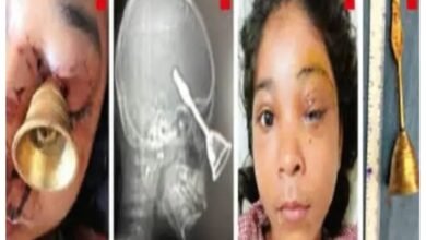 Diwali Accident: A tragic Diwali accident in Bilaspur! A prayer bell entered the eye of a 10-year-old child... A successful operation was performed at DKS.