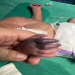 Private Nursing Homes: Negligence of doctors and staff at the nursing home! An infant was given an injection incorrectly...now the newborn's hand will have to be amputated.