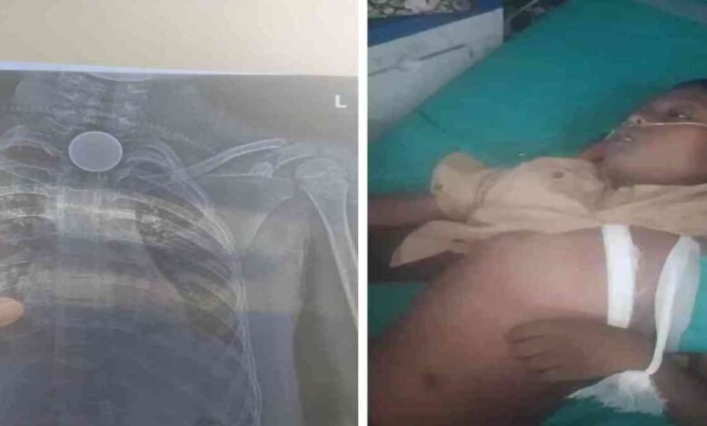 Coin Stuck: Heartbreaking incident from Korba! 8-year-old boy swallows coin... painful death... family distraught