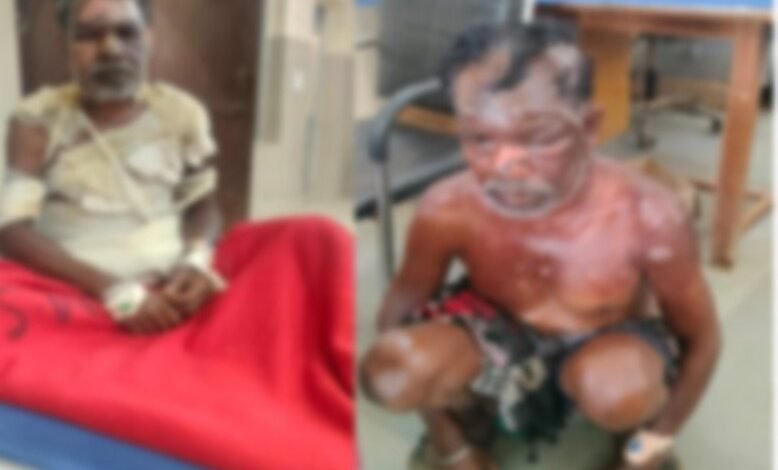 Domestic Violence: Horrific Incident in Chhattisgarh! Wife Sets Husband Ablaze After Being Stopped from Brewing Liquor—Condition Critical.