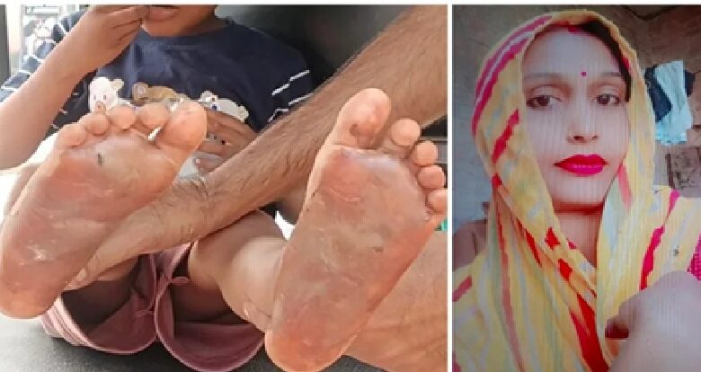 Child Abuse: Driven by a craving for intoxicants, a mother inflicted a horrific punishment on her 6-year-old son! She gave him ₹20 to fetch *gutkha*; when he spent ₹5 of it, she branded the soles of his feet with a hot knife, locked him in the room, and left for a birthday party.